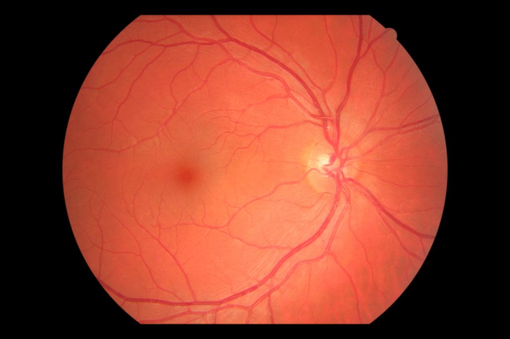 Normal eye